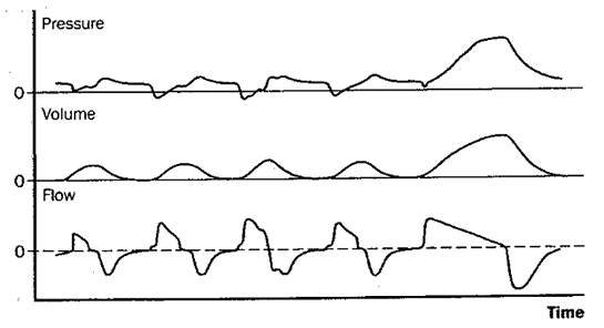 changes in pressure during SMIV