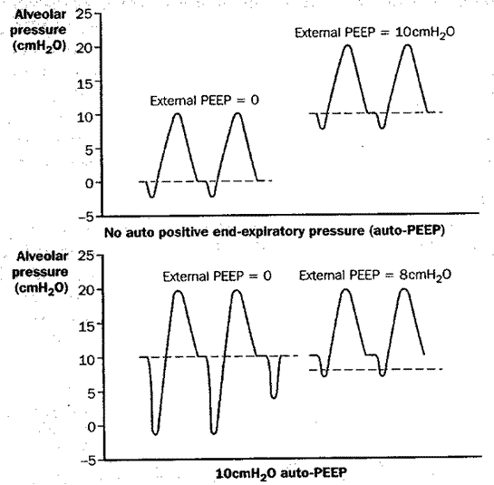 changes in pressure during PCV